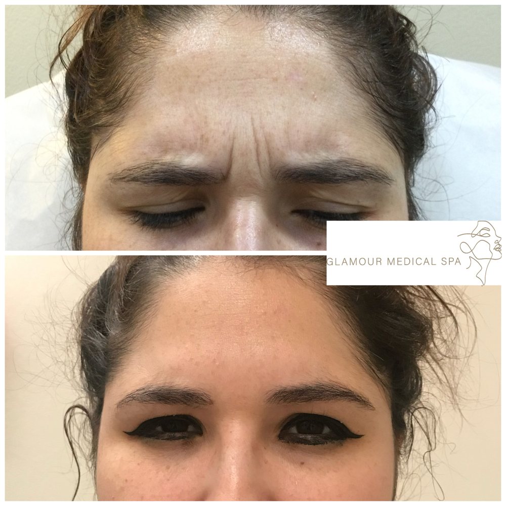 Before and after Botox frown-line treatment by Dr. Mandana Semnani, MD at Glamour Medical Spa