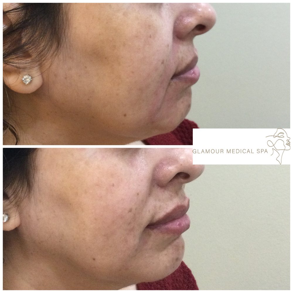 Before and after jawline and profile refinement by Dr. Mandana Semnani, MD