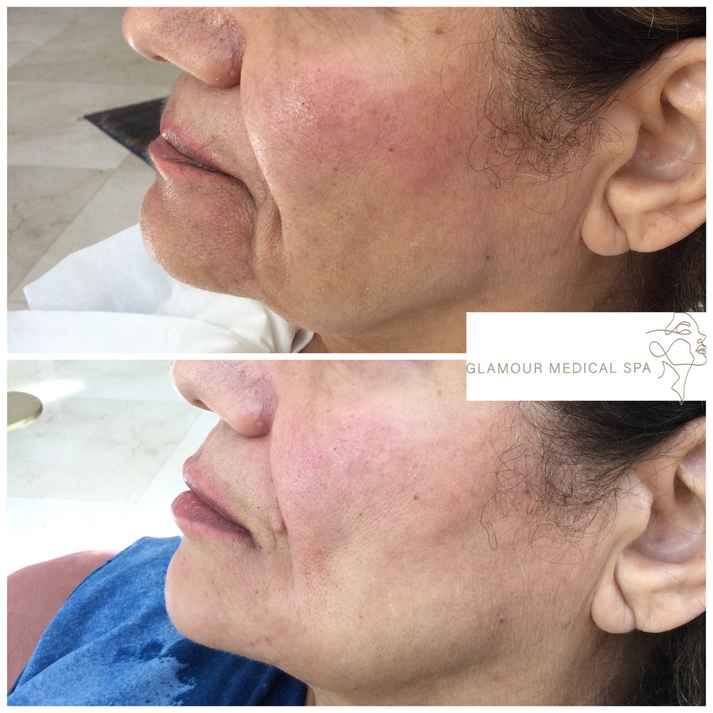 Before and after jawline contouring by Dr. Mandana Semnani, MD