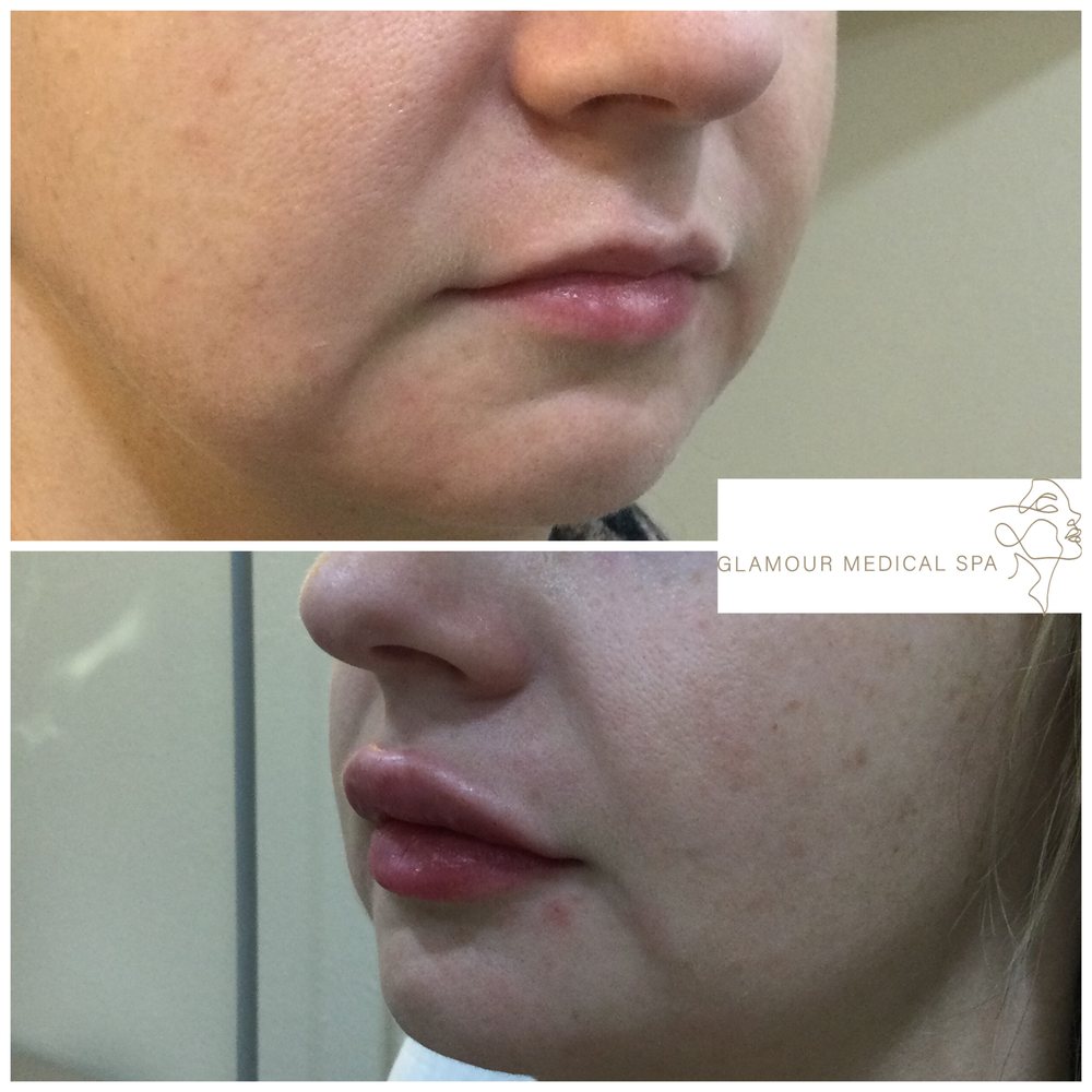 Before and after lip and jawline harmony treatment by Dr. Mandana Semnani, MD