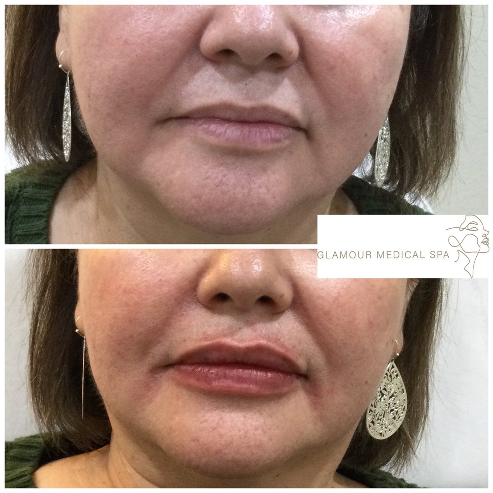 Before and after lip enhancement with dermal filler by Dr. Mandana Semnani, MD