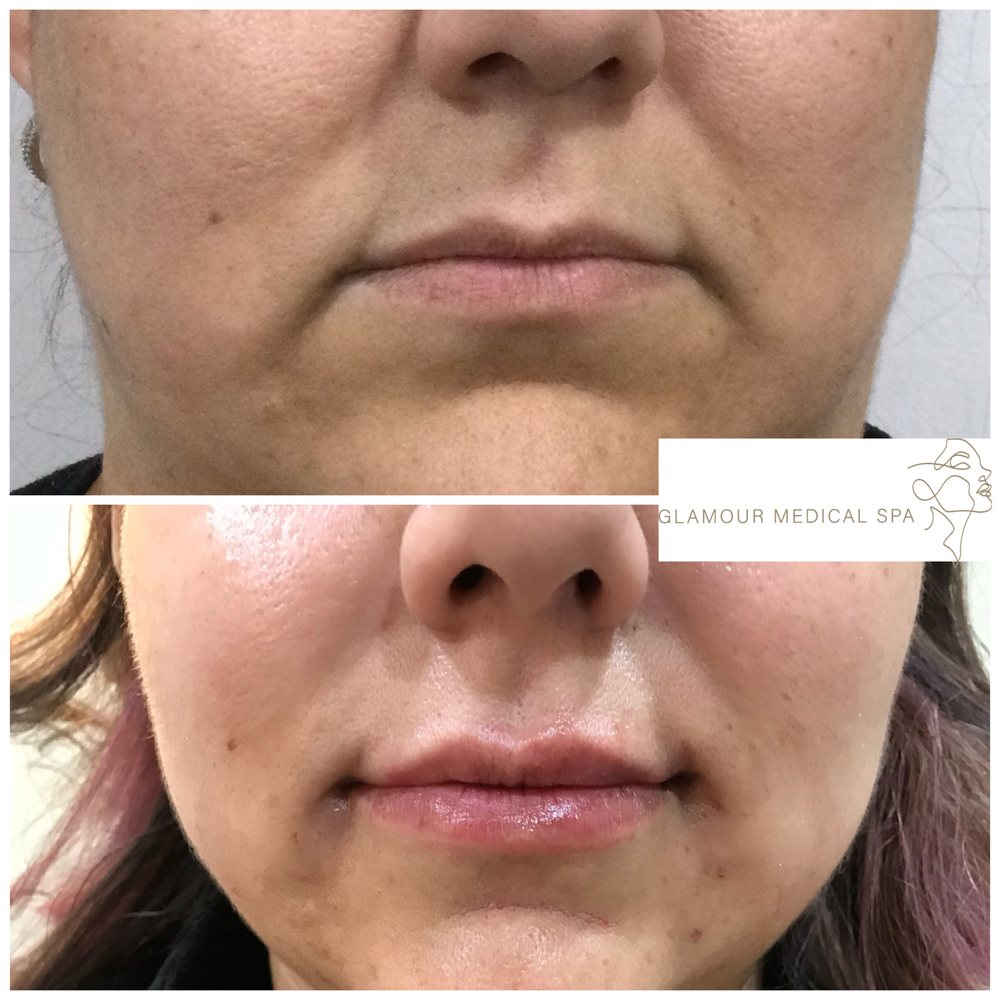 Before and after lip and perioral filler by Dr. Mandana Semnani, MD