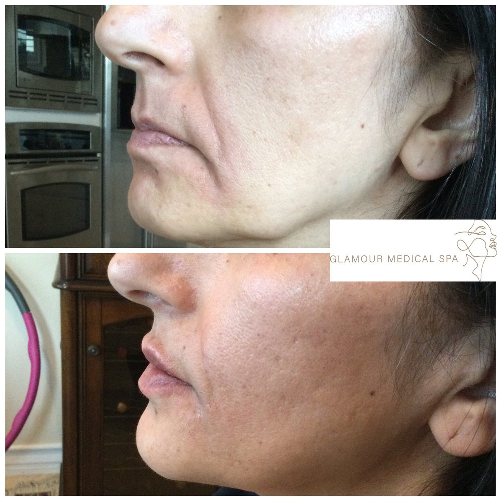 Before and after nasolabial fold dermal filler by Dr. Mandana Semnani, MD