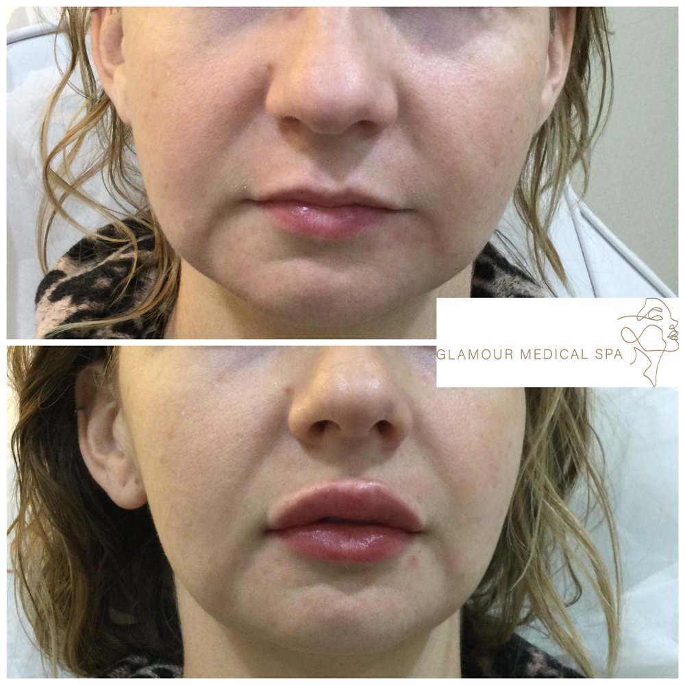 Before and after cheek and midface filler by Dr. Mandana Semnani, MD