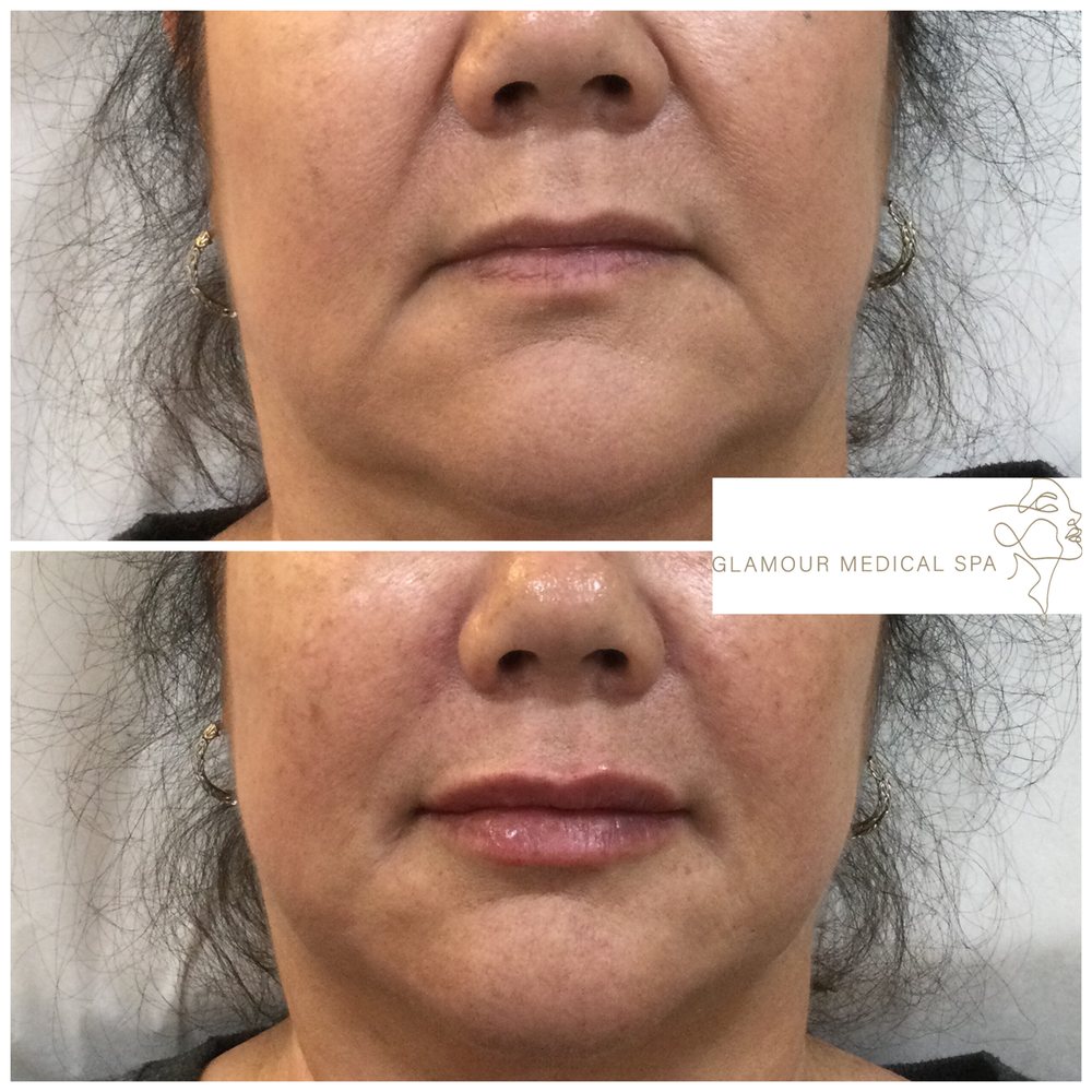 Before and after full-face aesthetic rejuvenation by Dr. Mandana Semnani, MD