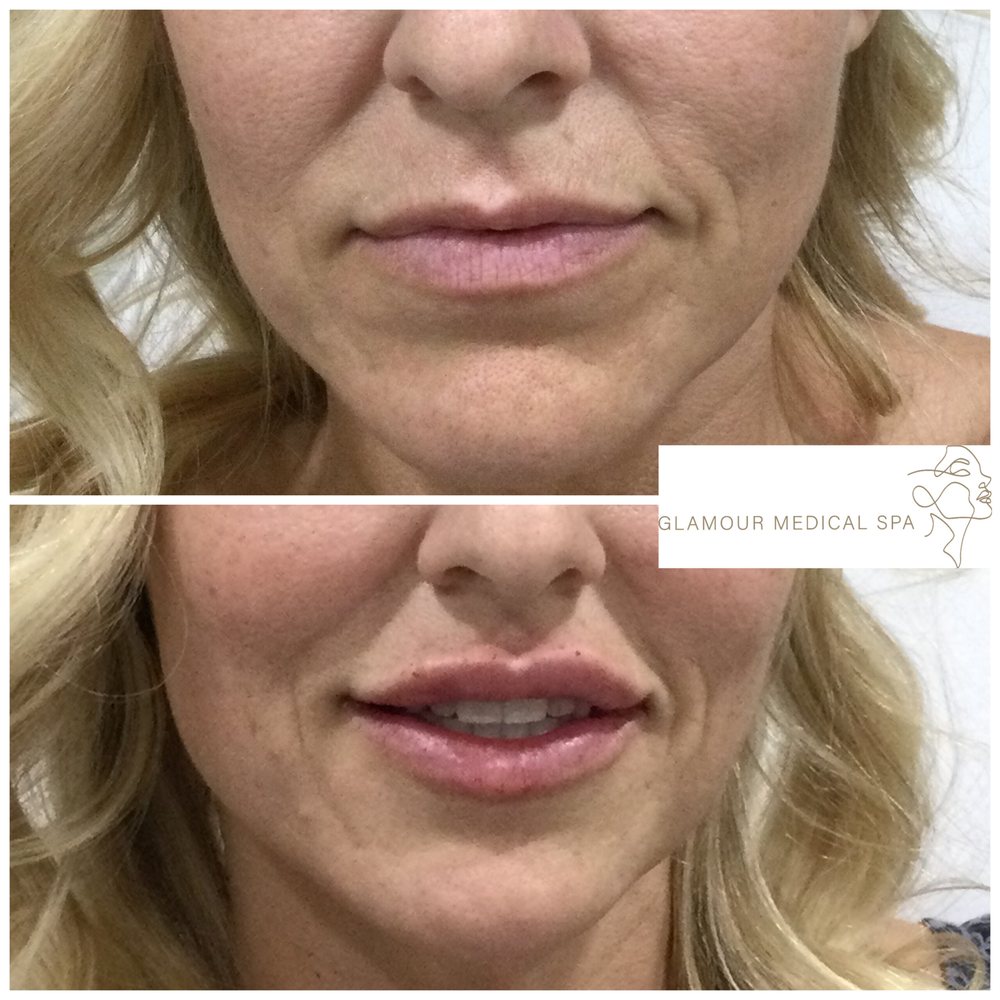 Before and after lip volume restoration by Dr. Mandana Semnani, MD