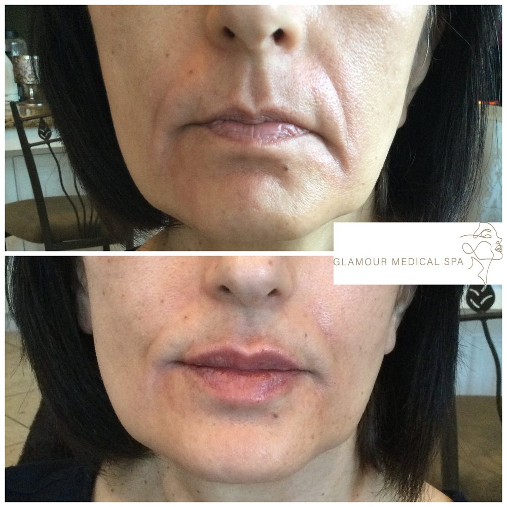 Before and after lip and lower-face filler by Dr. Mandana Semnani, MD
