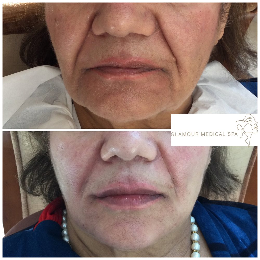 Before and after perioral rejuvenation by Dr. Mandana Semnani, MD